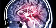 How Long Does It Take To Recover After A Stroke Encompass Health