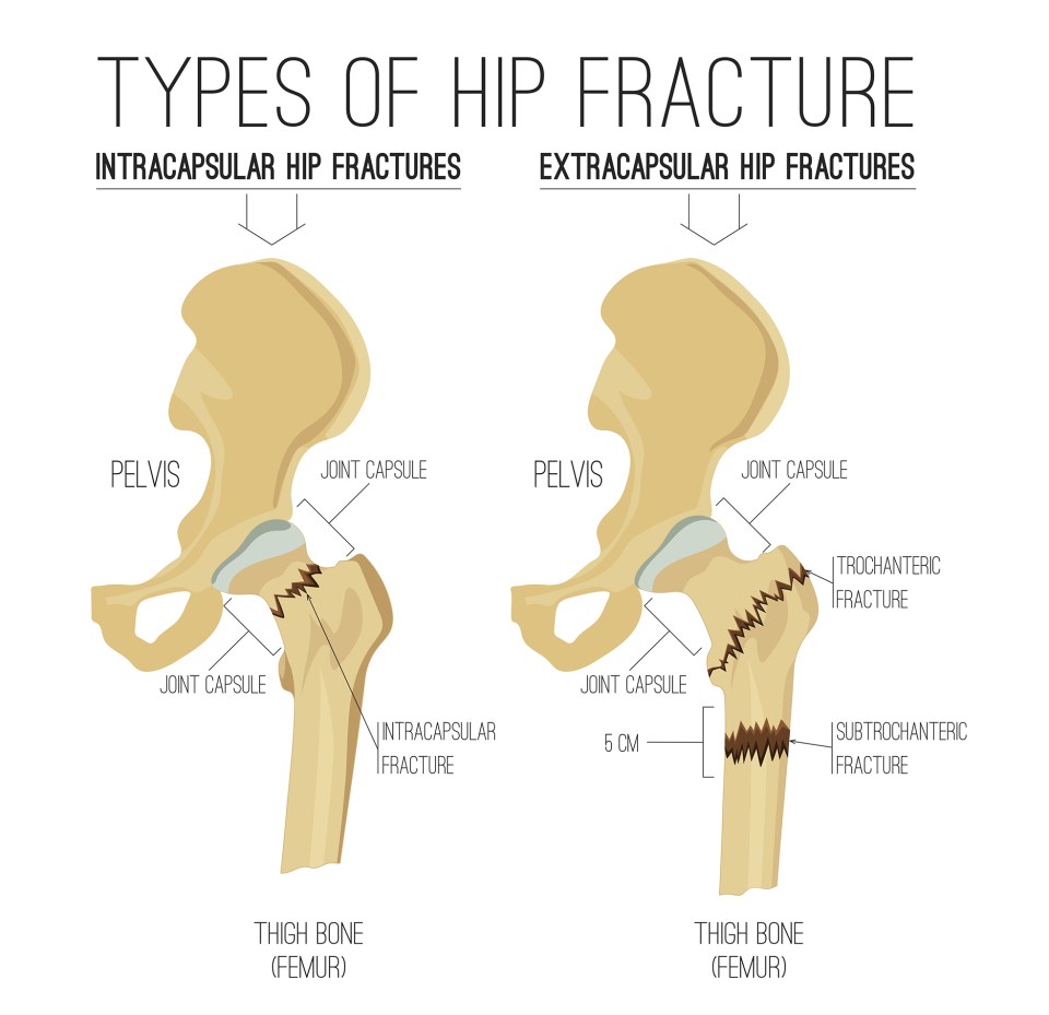 hip fracture types