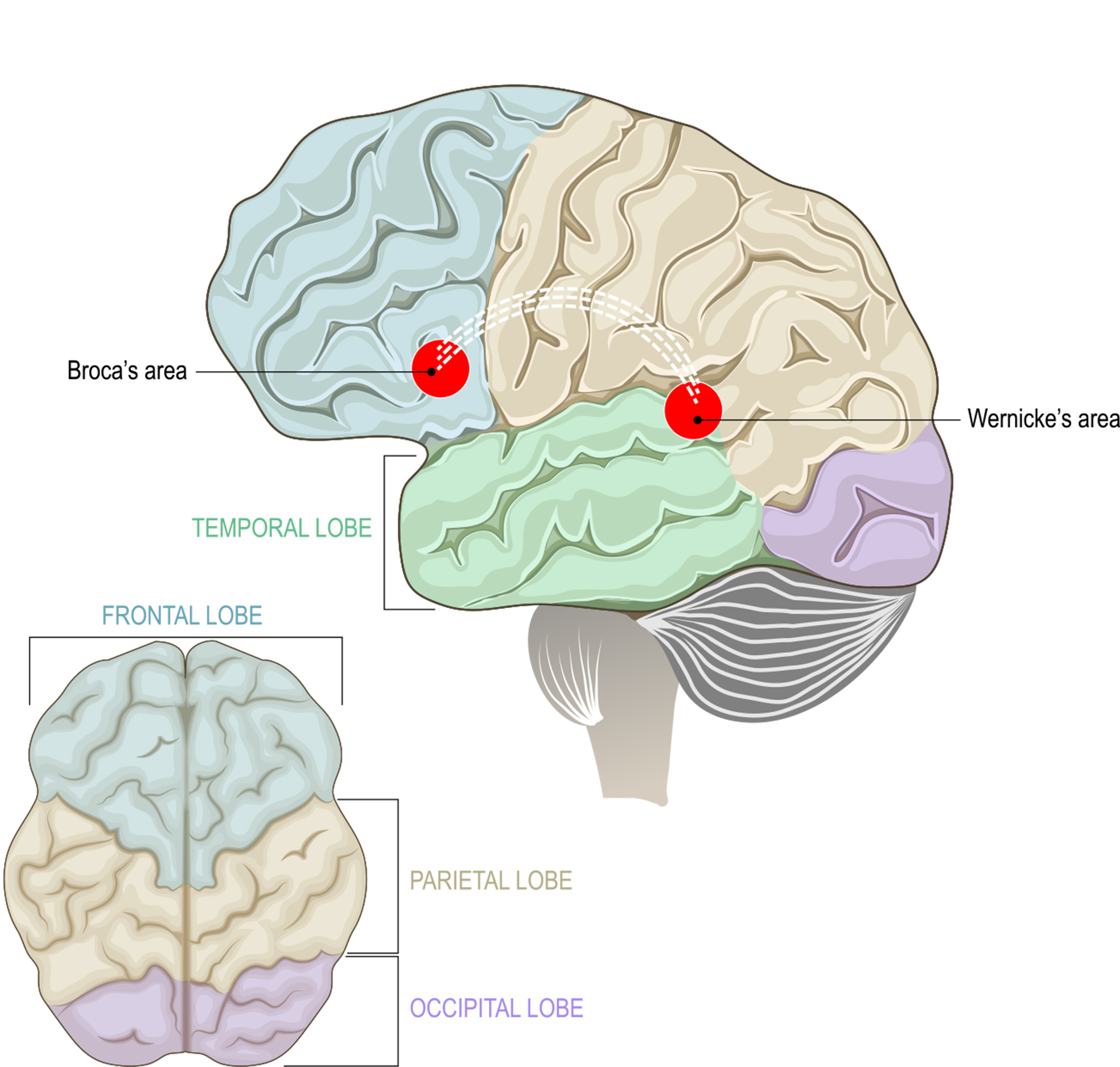 Types of Aphasia: What They are and How They're Treated