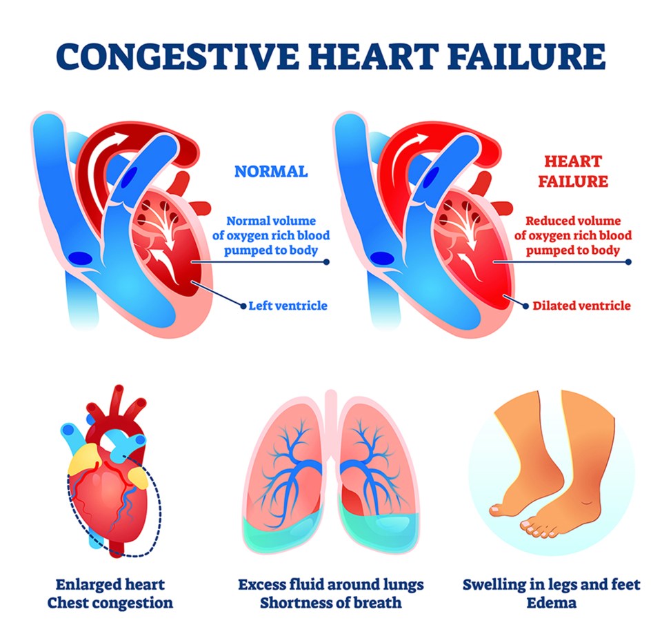 Congestive Heart failure normal heart vs heart failure