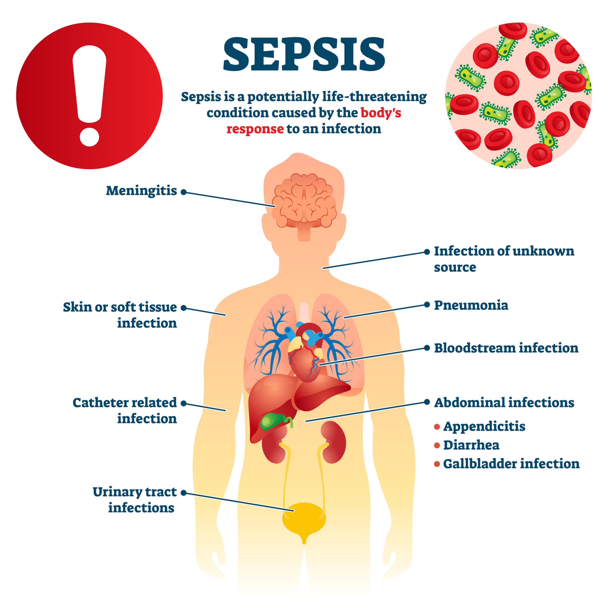 what is sepsis infographic