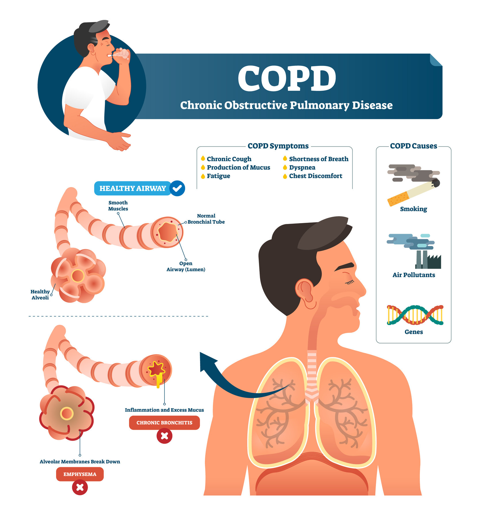 COPD Stages, Symptoms and Treatment