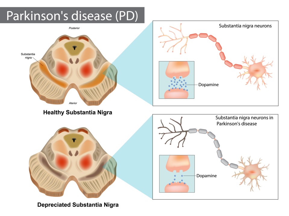 graphic on what is parkinson's